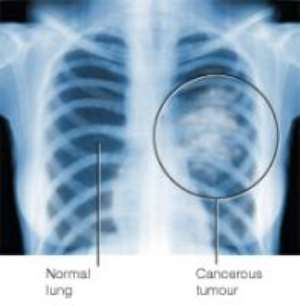 Lung Cancer- symptoms, types  treatment