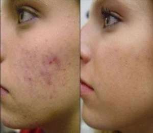 A natural approach to managing acne