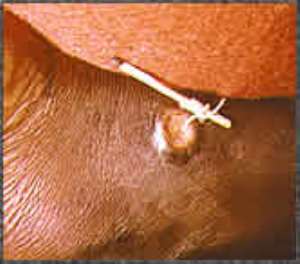Ghana Health Service has reported a drastic reduction in Guineaworm cases in the country