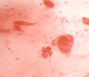 Gonorrhea bacteria causes a sexually-transmitted infection in about 106 million people worldwide each year.