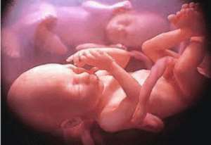 2500 Unsafe Abortions - Cytotec Use Could Cause Infertility And Death