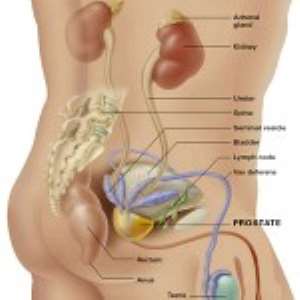 New treatment for prostate cancer gives perfect results for nine in ten men