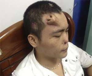 Xiaolian, 22, had a new nose grown on his forehead after his original one was irreparably damaged in a traffic accident. The new nose was sculpted from cartilage taken from his ribs