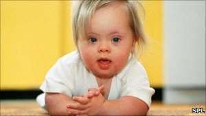 Down's syndrome is caused by one too many copies of chromosome 21