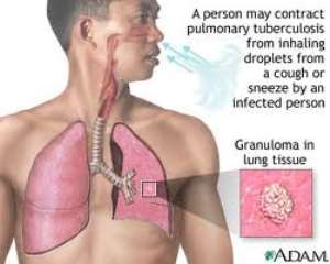 International Respiratory Societies To Assist In Finding The 3 Million Missed TB Cases