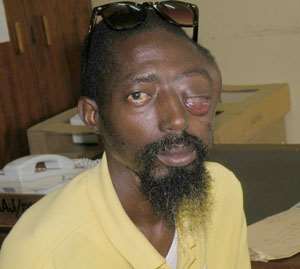 Man Loses Eye To Police Brutality