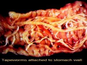 Indian Doctors` Shocker! 1st Lady Dying of Tapeworm Infection