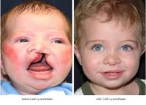 Mtn Supports Cleft Lip And Palate Patients