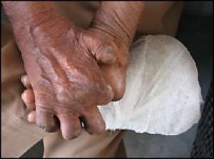 Ghana makes progress in the fight against leprosy