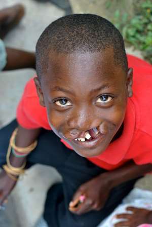 Operation Smile Gives to Smiles 90 Children in Ghana