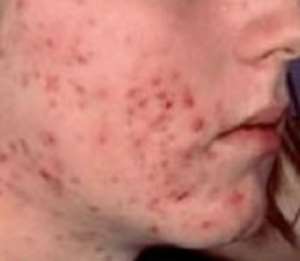 Natural relief for painful and itchy acne