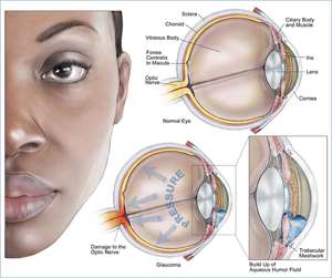 Glaucoma Leading Cause Of Blindness