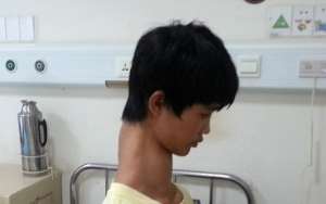 Chinese teenager to undergo surgery on his extraordinary long neck