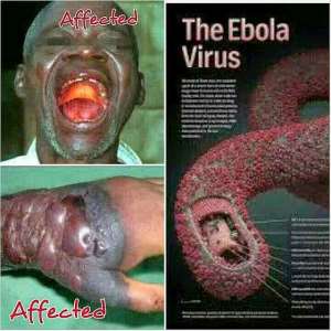 Statement  On The Ebola Virus By Health Education On Wheels