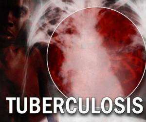 TB patients advised to take drugs religiously