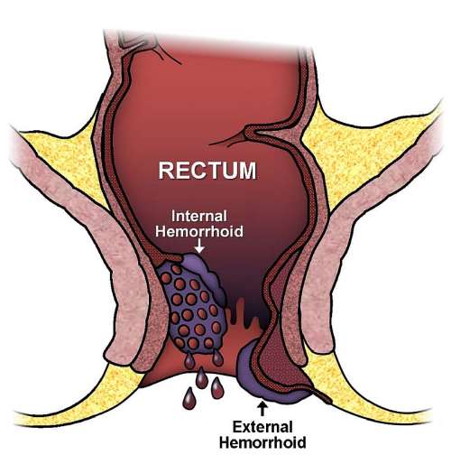 Hemorrhoids How To Manage Common Piles