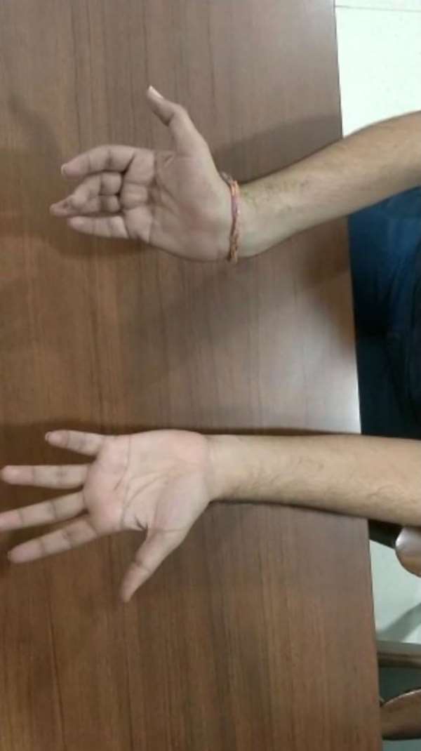 All You Need To Know About Hirayama Disease