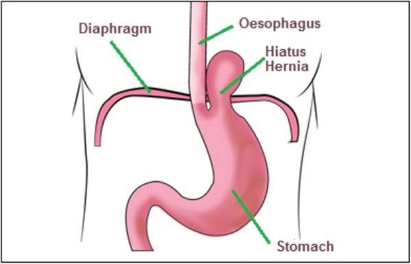Hiatal Hernia