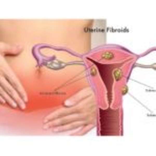 What You Need To Know About Fibroids