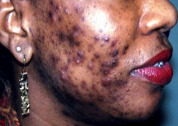 The Identity Crisis Of Skin Bleaching