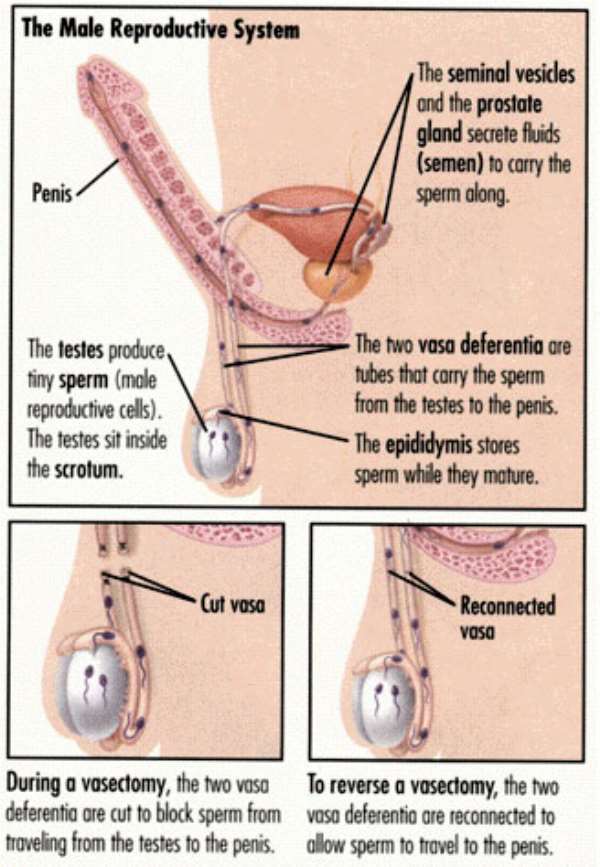 Breaking down the barriers of vasectomy ...