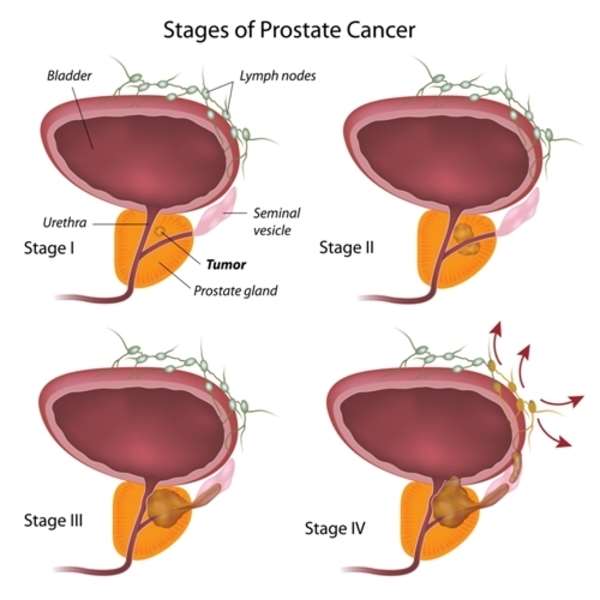 What Is The Best Treatment For T3a Prostate Cancer