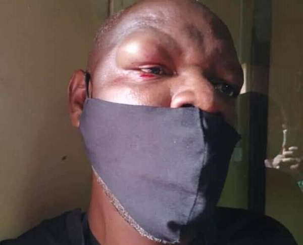 Zambian journalist Francis Mwiinga Maingaila is seen after he and another journalist were attacked by supporters of the ruling Patriotic Front. (Photo: Francis Mwiinga Maingaila)