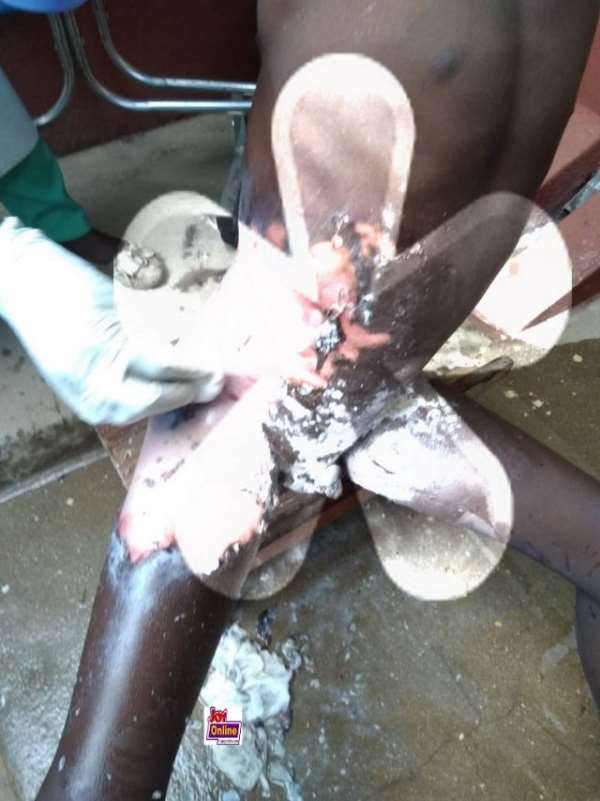 Mother Boils Her 11-Year-Old Son Over Missing One Ghana Cedi