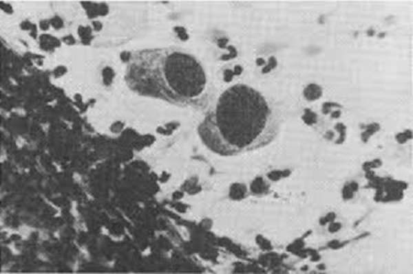 Bird's eye cells