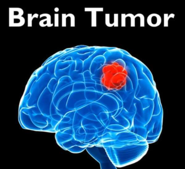 Brain Tumor Can Strike At Any Age, Be Observant