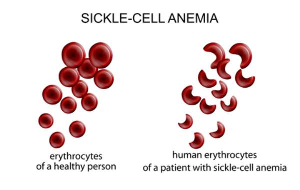 Sickle Cell Foundation Of Ghana, Novartis Deploy Mobile Digital Solution To Support Newborn Screening For Sickle Cell Disease