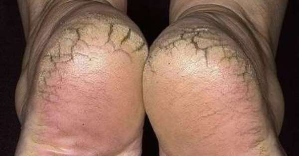 This Easy Home Remedy Is The Solution To Cracked Feet