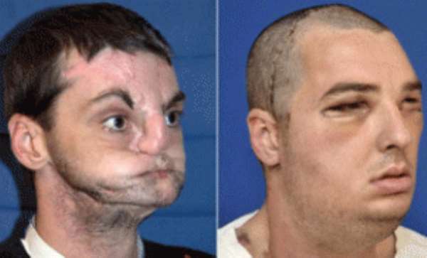 Richard Lee Norris - Before and after the transplant