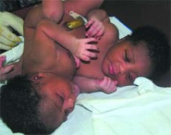 The siamese twins after delivery