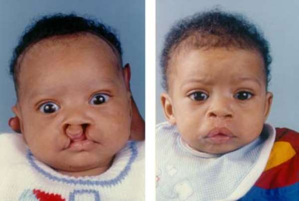 Folic acid cuts risk of cleft lip