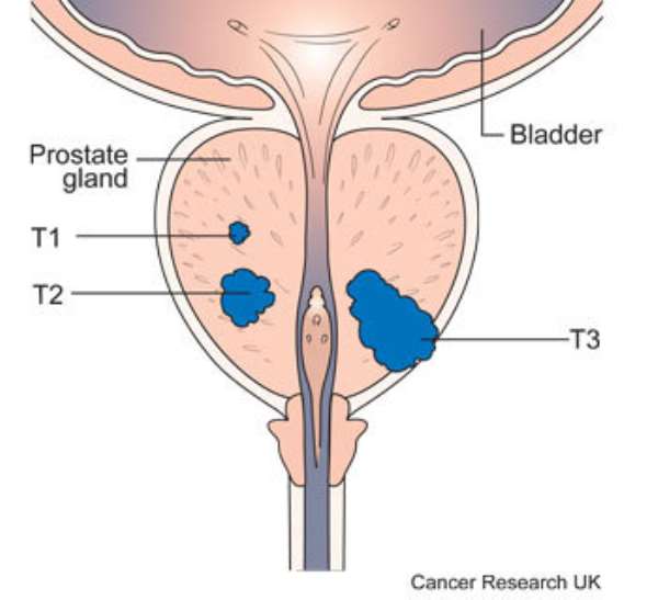 Doing Prostate Massage: My Research on why Some Men opt for Anal Sex orientation?