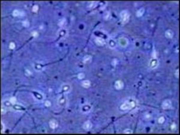 Gene defect clue to male pill