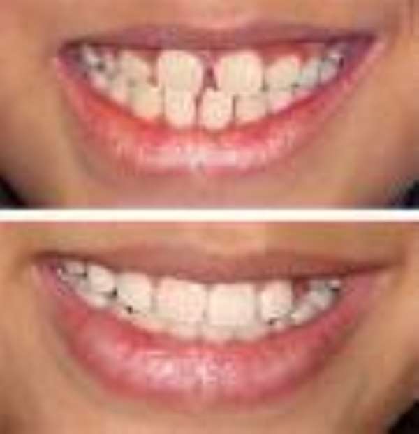 How the food you eat affects your teeth