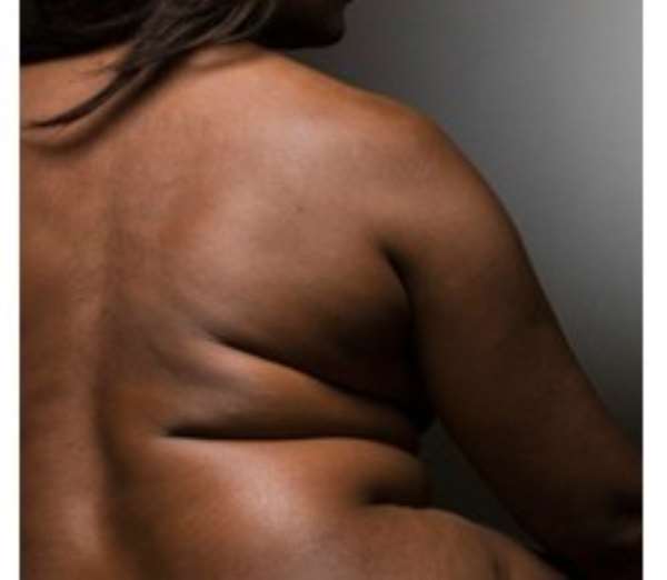 Study finds obesity can 'lead to lack of vitamin D'