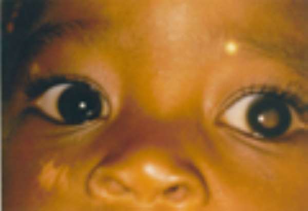Refrain from herbal eye treatment - Ophthalmologist