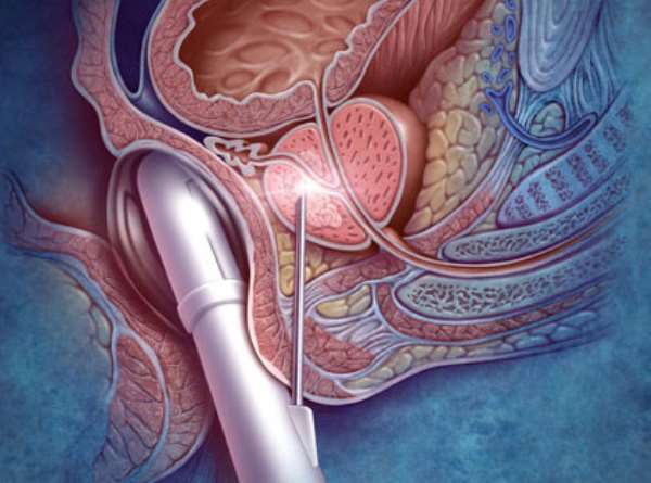 Study Reveals Similar Survival Of African American & White Men With Prostate Cancer