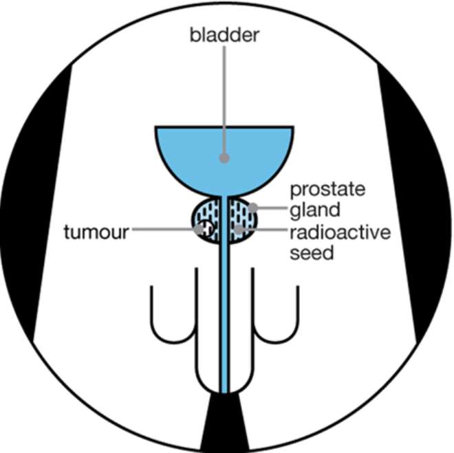 Prostate Miling