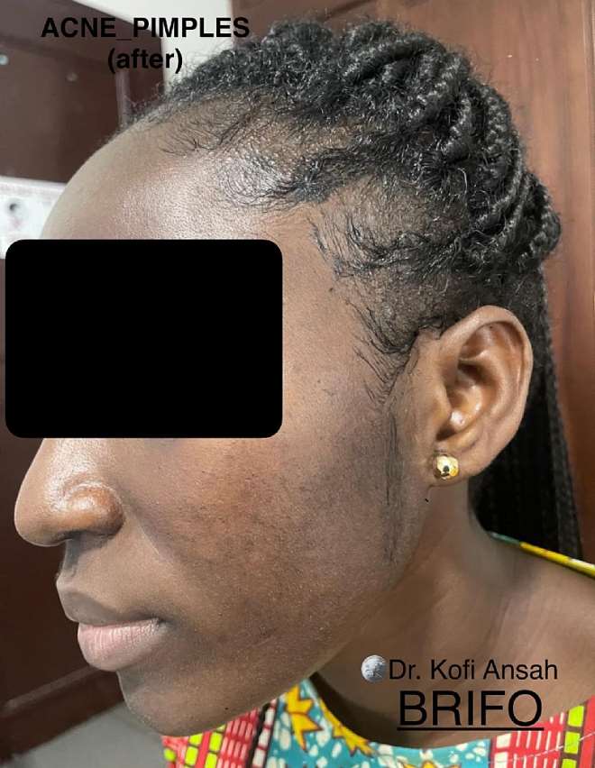 520202522538-swnaqdcp53-acne-pimples-after-treatment