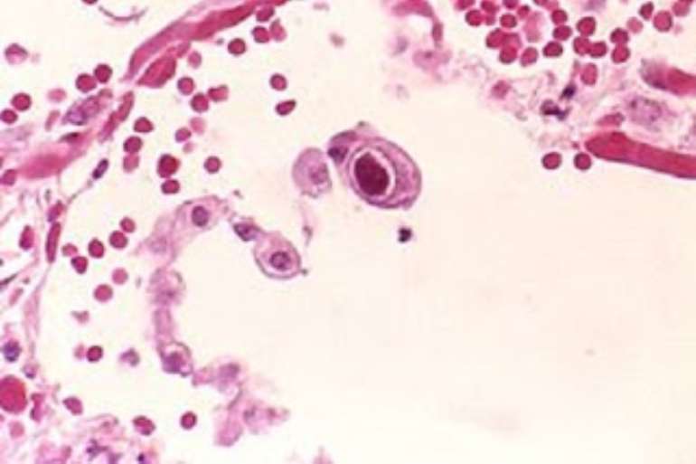 628201975758 0g830m4yxt cytomegalovirus