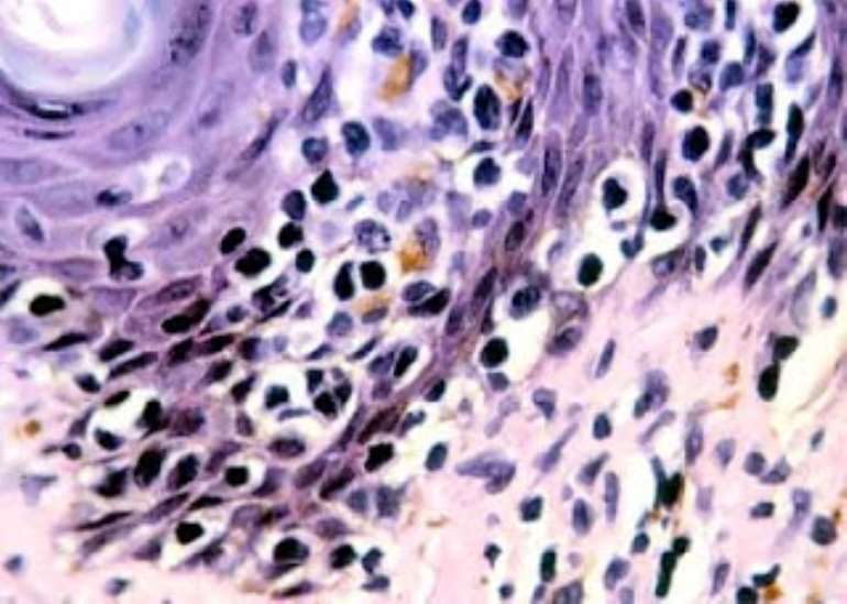 628201975758 vaqduhgtsn mycosis2bfungoids