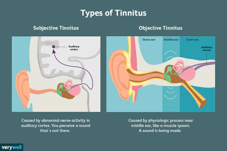 710202295004-1i830o4bau-tinnitus208