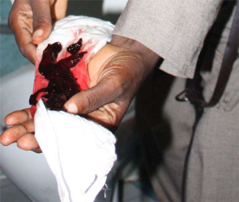 a woman holding fibriod that came out of her
