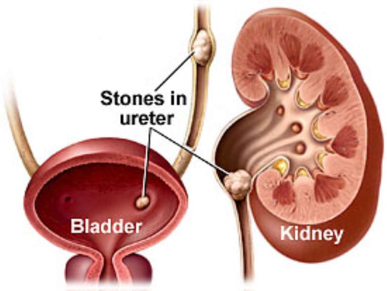 renalstones