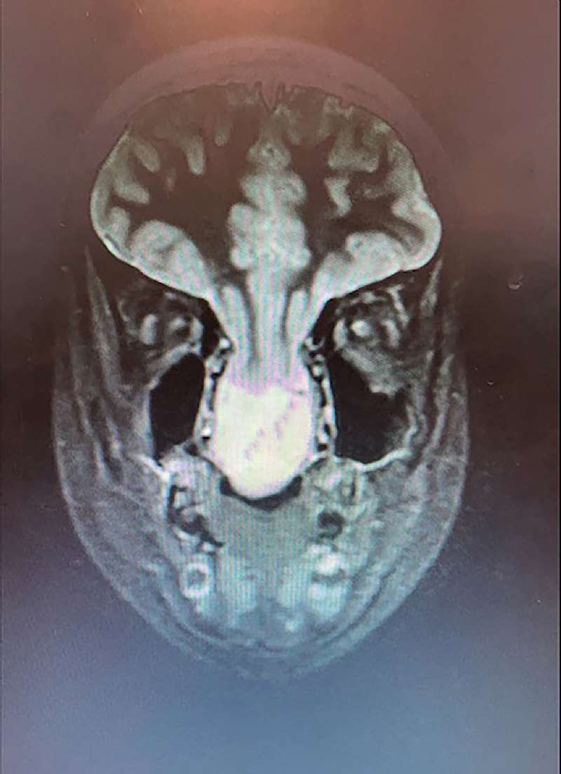 43202152049-vbqduhgtsn-x-ray-image-2-1