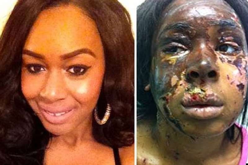 4. BEFORE AND AFTER AN ACID ATTACK ON NAOMI ONI IN LONDON